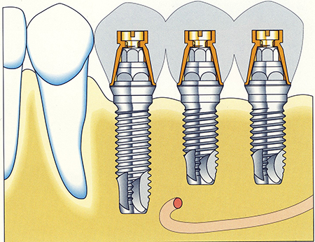 Implantate, Implantatbehandlung, Künstliche Zähne, Künstliche Zahnwurzel, Noble Biocare
